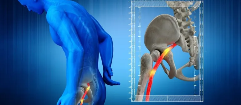 Sciatica Relief at Home: How Ayurvedic Massages Reduce Nerve Pain