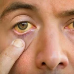 Gambhirika Eye Disorder – Meaning, Symptoms, Causes & Ayurveda Understanding