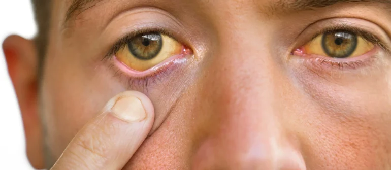 Gambhirika Eye Disorder – Meaning, Symptoms, Causes & Ayurveda Understanding