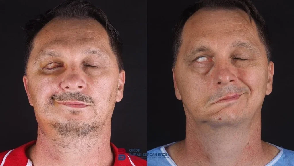 Paralysis Massage at Home in Chennai: Ayurvedic Treatment for Facial Paralysis (Ardita)