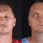 Paralysis Massage at Home in Chennai: Ayurvedic Treatment for Facial Paralysis (Ardita)