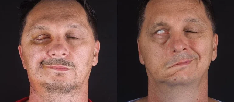 Paralysis Massage at Home in Chennai: Ayurvedic Treatment for Facial Paralysis (Ardita)