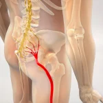 Ayurveda Treatment for Sciatica Pain: Understanding Gridhrasi and Ayurvedic Care