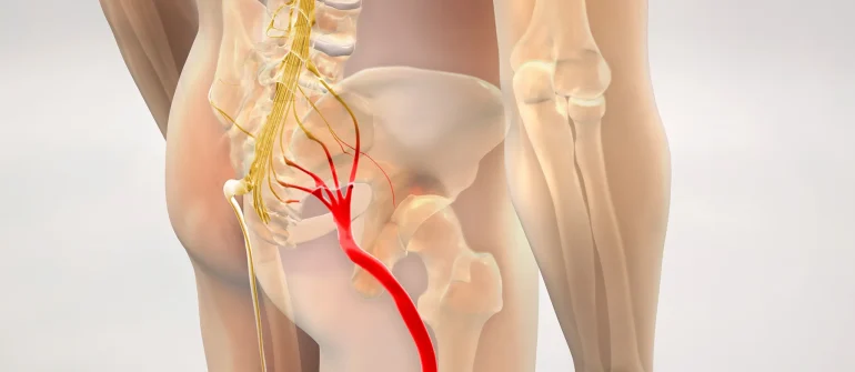 Ayurveda Treatment for Sciatica Pain: Understanding Gridhrasi and Ayurvedic Care